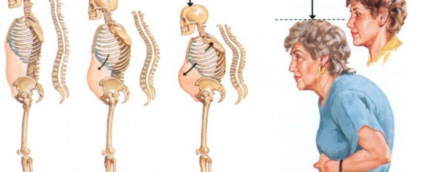 Измервания на костна плътност по повод 20 октомври: Световен ден за борба с остеопорозата
